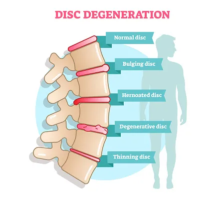 The-Best-Degenerative-Disc-Disease-Treatment